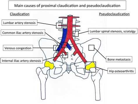 side lying iliac compression test|iliac vein stenosis symptoms.